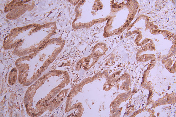 IHC image of CSB-RA986091A0HU diluted at 1:100 and staining in paraffin-embedded human cervical cancer performed on a Leica BondTM system. After dewaxing and hydration, antigen retrieval was mediated by high pressure in a citrate buffer (pH 6.0) . Section was blocked with 10% normal goat serum 30min at RT. Then primary antibody (1% BSA) was incubated at 4°C overnight. The primary is detected by a Goat anti-rabbit polymer IgG labeled by HRP and visualized using 0.05% DAB.