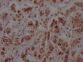 IHC image of CSB-RA986790A0HU diluted at 1:100 and staining in paraffin-embedded human breast cancer performed on a Leica BondTM system. After dewaxing and hydration, antigen retrieval was mediated by high pressure in a citrate buffer (pH 6.0) . Section was blocked with 10% normal goat serum 30min at RT. Then primary antibody (1% BSA) was incubated at 4℃ overnight. The primary is detected by a Goat anti-rabbit IgG polymer labeled by HRP and visualized using 0.05% DAB.
