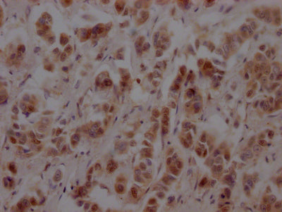 IHC image of CSB-RA986790A0HU diluted at 1:100 and staining in paraffin-embedded human breast cancer performed on a Leica BondTM system. After dewaxing and hydration, antigen retrieval was mediated by high pressure in a citrate buffer (pH 6.0) . Section was blocked with 10% normal goat serum 30min at RT. Then primary antibody (1% BSA) was incubated at 4℃ overnight. The primary is detected by a Goat anti-rabbit IgG polymer labeled by HRP and visualized using 0.05% DAB.