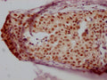 IHC image of CSB-RA988421A0HU diluted at 1:100 and staining in paraffin-embedded human breast cancer performed on a Leica BondTM system. After dewaxing and hydration, antigen retrieval was mediated by high pressure in a citrate buffer (pH 6.0) . Section was blocked with 10% normal goat serum 30min at RT. Then primary antibody (1% BSA) was incubated at 4℃ overnight. The primary is detected by a Goat anti-rabbit IgG polymer labeled by HRP and visualized using 0.05% DAB.