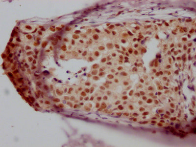 IHC image of CSB-RA988421A0HU diluted at 1:100 and staining in paraffin-embedded human breast cancer performed on a Leica BondTM system. After dewaxing and hydration, antigen retrieval was mediated by high pressure in a citrate buffer (pH 6.0) . Section was blocked with 10% normal goat serum 30min at RT. Then primary antibody (1% BSA) was incubated at 4℃ overnight. The primary is detected by a Goat anti-rabbit IgG polymer labeled by HRP and visualized using 0.05% DAB.