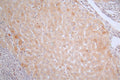 IHC image of CSB-RA988767A0HU diluted at 1:50 and staining in paraffin-embedded human liver cancer performed on a Leica BondTM system. After dewaxing and hydration, antigen retrieval was mediated by high pressure in a citrate buffer (pH 6.0) . Section was blocked with 10% normal goat serum 30min at RT. Then primary antibody (1% BSA) was incubated at 4°C overnight. The primary is detected by a Goat anti-rabbit polymer IgG labeled by HRP and visualized using 0.38% DAB.