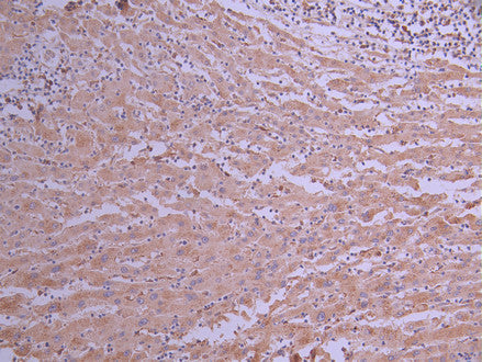 IHC image of CSB-RA991818A0HU diluted at 1:100 and staining in paraffin-embedded human liver cancer performed on a Leica BondTM system. After dewaxing and hydration, antigen retrieval was mediated by high pressure in a citrate buffer (pH 6.0) . Section was blocked with 10% normal goat serum 30min at RT. Then primary antibody (1% BSA) was incubated at 4°C overnight. The primary is detected by a Goat anti-rabbit polymer IgG labeled by HRP and visualized using 0.05% DAB.