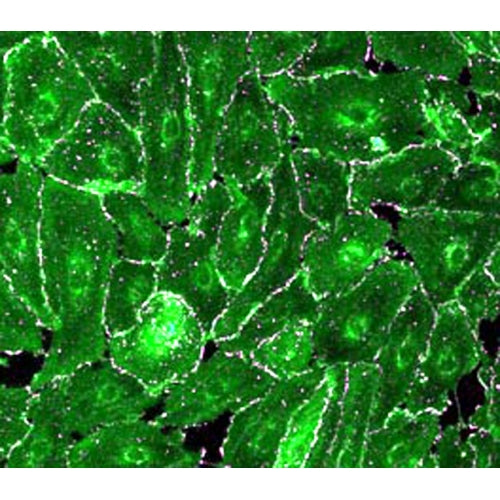 Human Ovarian Metastatic Tumor Epithelial Cells – Figure 1 of 1
