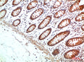 Immunohistochemical analysis of paraffin-embedded Human Colon Carcinoma Tissue using HIF-1α（EA335）Rabbit pAb diluted at 1:200