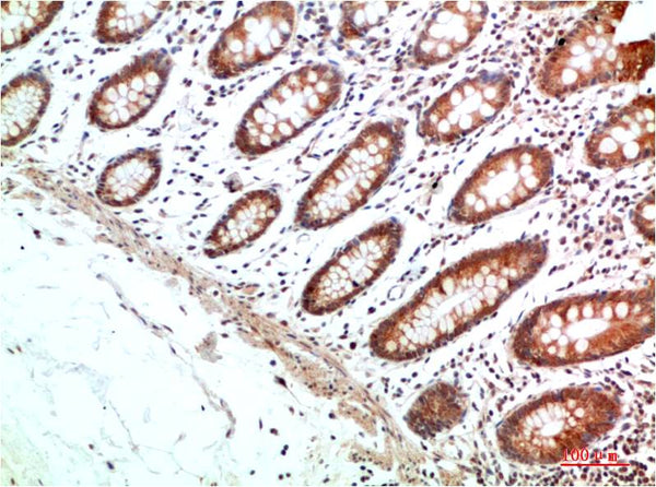 Immunohistochemical analysis of paraffin-embedded Human Colon Carcinoma Tissue using HIF-1α（EA335）Rabbit pAb diluted at 1:200