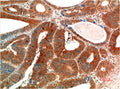 Immunohistochemical analysis of paraffin-embedded Human Colon Carcinoma Tissue using Phospho-ERK1/2(EM1342)Mouse mAb diluted at 1:200.