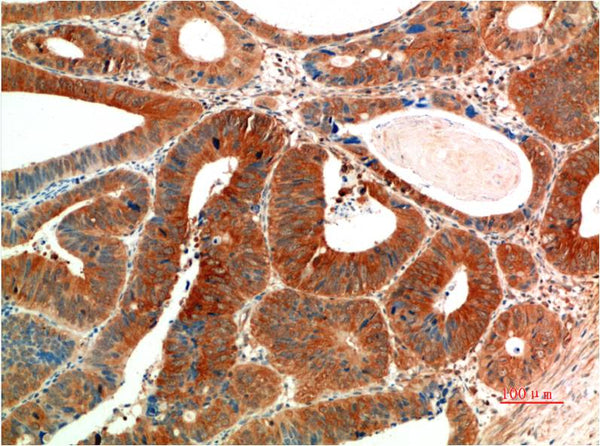 Immunohistochemical analysis of paraffin-embedded Human Colon Carcinoma Tissue using Phospho-ERK1/2(EM1342)Mouse mAb diluted at 1:200.