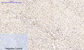 Immunohistochemical analysis of paraffin-embedded Human-uterus-cancer tissue.
