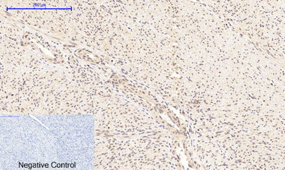 Immunohistochemical analysis of paraffin-embedded Human-uterus-cancer tissue.