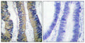 Immunohistochemical analysis of paraffin-embedded Human colon cancer. Antibody was diluted at 1:100(4° overnight).  High-pressure and temperature Tris-EDTA,pH8.0 was used for antigen retrieval.  Negetive contrl (right) obtaned from antibody was pre-absorbed by immunogen peptide.