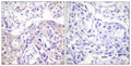 Immunohistochemistry analysis of paraffin-embedded human breast carcinoma, using ADD1 (Phospho-Thr445) Antibody. The picture on the right is blocked with the phospho peptide.