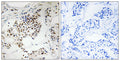 Immunohistochemistry analysis of paraffin-embedded human breast carcinoma, using SGOL2 Antibody. The picture on the right is blocked with the synthesized peptide.