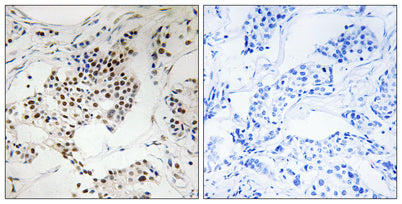 Immunohistochemistry analysis of paraffin-embedded human breast carcinoma, using SGOL2 Antibody. The picture on the right is blocked with the synthesized peptide.