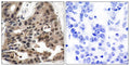 Immunohistochemistry analysis of paraffin-embedded human breast carcinoma tissue, using 4E-BP1 Antibody. The picture on the right is blocked with the synthesized peptide.