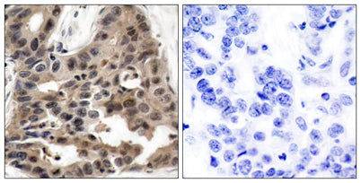 Immunohistochemistry analysis of paraffin-embedded human breast carcinoma tissue, using 4E-BP1 Antibody. The picture on the right is blocked with the synthesized peptide.