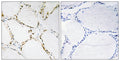 Immunohistochemistry analysis of paraffin-embedded human thyroid gland tissue, using FOXO1A/3A Antibody. The picture on the right is blocked with the synthesized peptide.