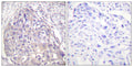 Immunohistochemistry analysis of paraffin-embedded human breast carcinoma, using FOXO1/3/4-pan (Phospho-Thr24/32) Antibody. The picture on the right is blocked with the phospho peptide.