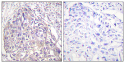 Immunohistochemistry analysis of paraffin-embedded human breast carcinoma, using FOXO1/3/4-pan (Phospho-Thr24/32) Antibody. The picture on the right is blocked with the phospho peptide.