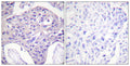 Immunohistochemistry analysis of paraffin-embedded human breast carcinoma tissue, using FOXO1/3/4-pan Antibody. The picture on the right is blocked with the synthesized peptide.