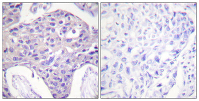 Immunohistochemistry analysis of paraffin-embedded human breast carcinoma tissue, using FOXO1/3/4-pan Antibody. The picture on the right is blocked with the synthesized peptide.
