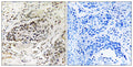 Immunohistochemistry analysis of paraffin-embedded human lung carcinoma tissue, using APBA2 Antibody. The picture on the right is blocked with the synthesized peptide.