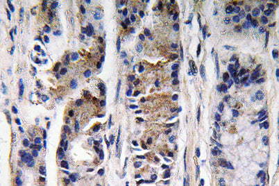 Immunohistochemistry analysis of Pepsin C antibody in paraffin-embedded human lung carcinoma tissue.