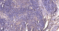 Immunohistochemical analysis of paraffin-embedded human cervical carcinoma. 1, Antibody was diluted at 1:200(4° overnight). 2, Tris-EDTA,pH9.0 was used for antigen retrieval. 3,Secondary antibody was diluted at 1:200(room temperature, 45min).