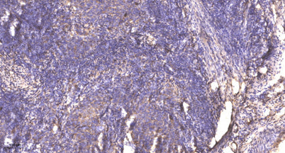 Immunohistochemical analysis of paraffin-embedded human cervical carcinoma. 1, Antibody was diluted at 1:200(4° overnight). 2, Tris-EDTA,pH9.0 was used for antigen retrieval. 3,Secondary antibody was diluted at 1:200(room temperature, 45min).