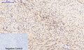 Immunohistochemical analysis of paraffin-embedded Human-uterus-cancer tissue. 1,PTEN (phospho Ser380/T382/T383) Polyclonal Antibody was diluted at 1:200(4°C,overnight). 2, Sodium citrate pH 6.0 was used for antibody retrieval(>98°C,20min). 3,Secondary antibody was diluted at 1:200(room tempeRature, 30min). Negative control was used by secondary antibody only.