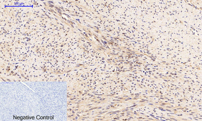 Immunohistochemical analysis of paraffin-embedded Human-uterus-cancer tissue. 1,PTEN (phospho Ser380/T382/T383) Polyclonal Antibody was diluted at 1:200(4°C,overnight). 2, Sodium citrate pH 6.0 was used for antibody retrieval(>98°C,20min). 3,Secondary antibody was diluted at 1:200(room tempeRature, 30min). Negative control was used by secondary antibody only.