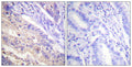 Immunohistochemistry analysis of paraffin-embedded human breast cancer, using PTEN (Phospho-Ser385) Antibody. The picture on the right is blocked with the PTEN (Phospho-Ser385) peptide.