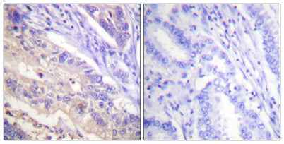 Immunohistochemistry analysis of paraffin-embedded human breast cancer, using PTEN (Phospho-Ser385) Antibody. The picture on the right is blocked with the PTEN (Phospho-Ser385) peptide.