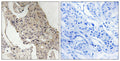 Immunohistochemistry analysis of paraffin-embedded human breast carcinoma, using Gab2 (Phospho-Ser623) Antibody. The picture on the right is blocked with the phospho peptide.