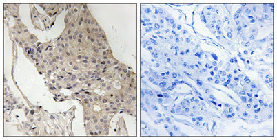 Immunohistochemistry analysis of paraffin-embedded human breast carcinoma, using Gab2 (Phospho-Ser623) Antibody. The picture on the right is blocked with the phospho peptide.