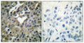 Immunohistochemical analysis of paraffin-embedded Human breast cancer. Antibody was diluted at 1:100(4° overnight).  High-pressure and temperature Tris-EDTA,pH8.0 was used for antigen retrieval.  Negetive contrl (right) obtaned from antibody was pre-absorbed by immunogen peptide.