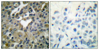 Immunohistochemical analysis of paraffin-embedded Human breast cancer. Antibody was diluted at 1:100(4° overnight).  High-pressure and temperature Tris-EDTA,pH8.0 was used for antigen retrieval.  Negetive contrl (right) obtaned from antibody was pre-absorbed by immunogen peptide.