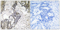 Immunohistochemistry analysis of paraffin-embedded human colon carcinoma, using CDC25C (Phospho-Ser198) Antibody. The picture on the right is blocked with the phospho peptide.