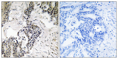 Immunohistochemistry analysis of paraffin-embedded human colon carcinoma, using CDC25C (Phospho-Ser198) Antibody. The picture on the right is blocked with the phospho peptide.