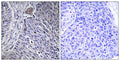 Immunohistochemistry analysis of paraffin-embedded human lung carcinoma tissue, using HNRPDL Antibody. The picture on the right is blocked with the synthesized peptide.