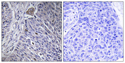 Immunohistochemistry analysis of paraffin-embedded human lung carcinoma tissue, using HNRPDL Antibody. The picture on the right is blocked with the synthesized peptide.