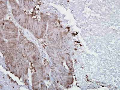 Mouse Anti-Hsp90 alpha Antibody [K41009] used in Immunohistochemistry (IHC) on Human colon carcinoma (SMC-108)