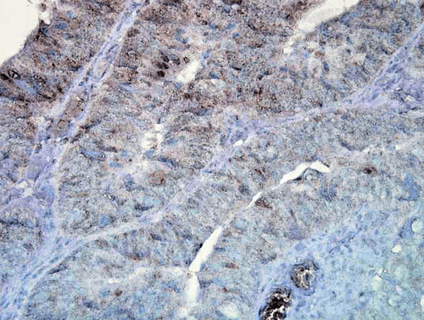 Mouse Anti-Hsp90 Antibody [D7alpha] used in Immunohistochemistry (IHC) on Human colon carcinoma (SMC-137)