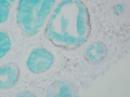 Mouse Anti-DNMT1 Antibody [60B1220.1] used in Immunohistochemistry (IHC) on Human colon carcinoma (SMC-200)