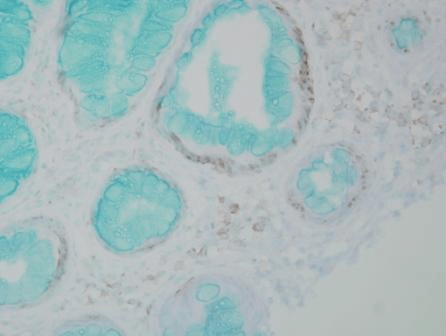 Mouse Anti-DNMT1 Antibody [60B1220.1] used in Immunohistochemistry (IHC) on Human colon carcinoma (SMC-200)