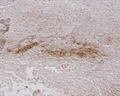 Mouse Anti-Alginate Antibody [4B10-1C5] used in Immunohistochemistry (IHC) on Human Burned Skin (SMC-208)