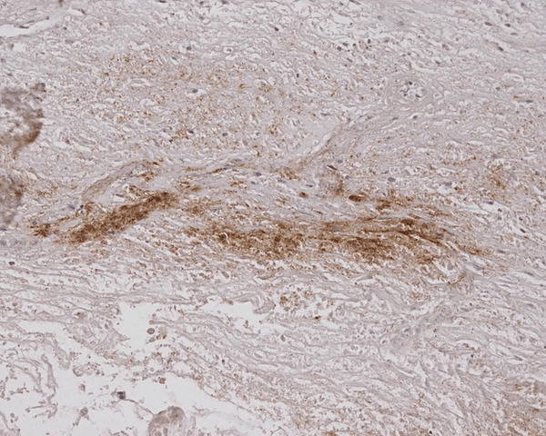 Mouse Anti-Alginate Antibody [4B10-1C5] used in Immunohistochemistry (IHC) on Human Burned Skin (SMC-208)