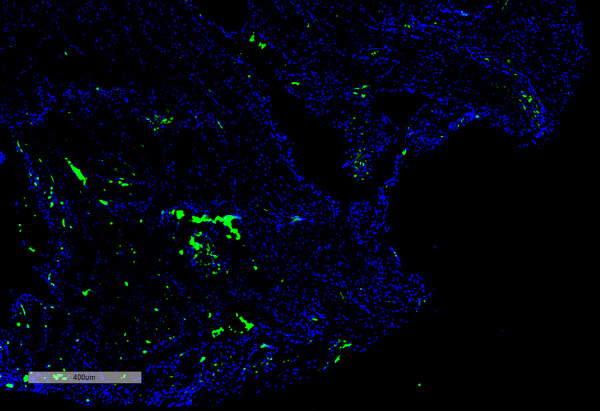 Mouse Anti-Citrulline Antibody [2D3.1] used in Immunohistochemistry (IHC) on Human Thyroid Cancer (SMC-500)