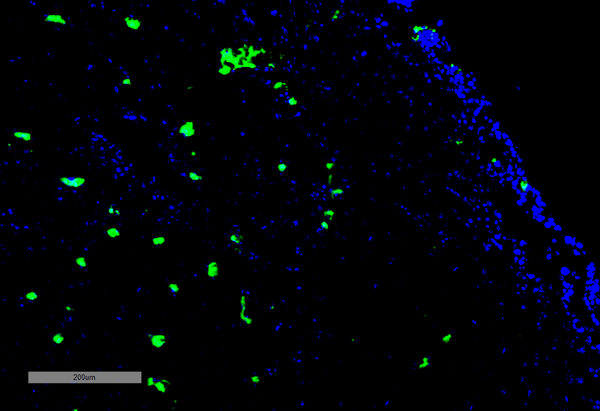Mouse Anti-Acrolein Antibody [10A10] used in Immunohistochemistry (IHC) on Human Adrenal Carcinoma (SMC-505)