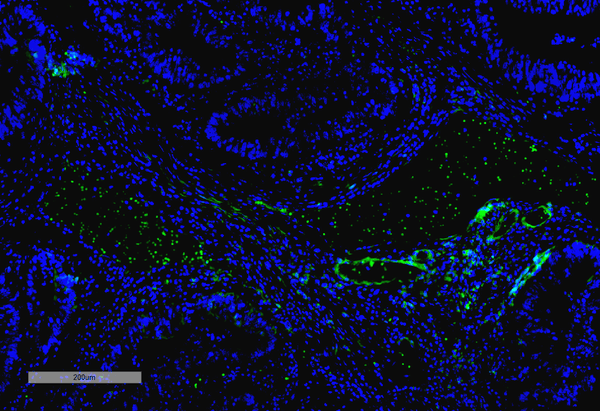 Mouse Anti-VPS35 Antibody [10A8] used in Immunohistochemistry (IHC) on Human Thyroid Cancer (SMC-605)